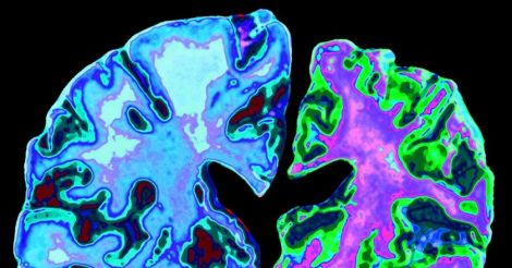ალცჰაიმერის დაავადება – Alzheimer’s disease – болезнь Альцгеймера