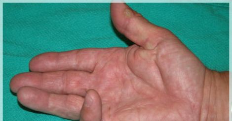 ანკილოზი – Ankylosis – анкилоз_6003f88f14630.jpeg