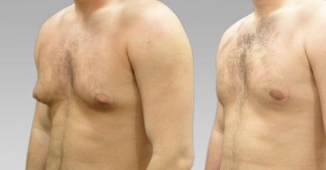 გინეკომასტია – Gynaecomastia – гинекомастия_6003f9aa470d7.jpeg